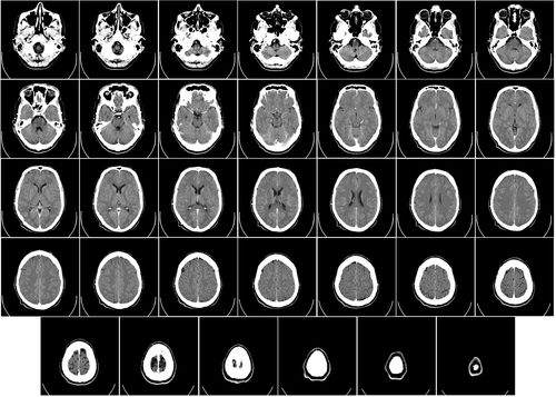 CAT scans of the human brain